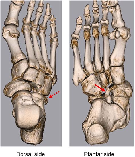 3d Ct Shows Lateral Dislocation Of The Naviculocuneiform And