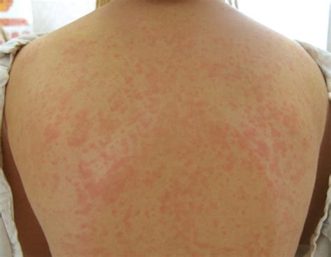 Maculopapular Rash Pictures Causes Treatment Diagnosis