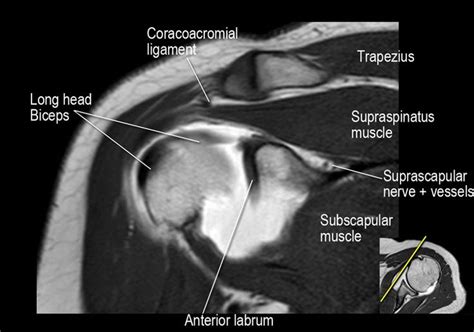 A bony overgrowth (spur) or calcification of the ligament. mri anatomy shoulder - Google Search | Bicep tendonitis ...