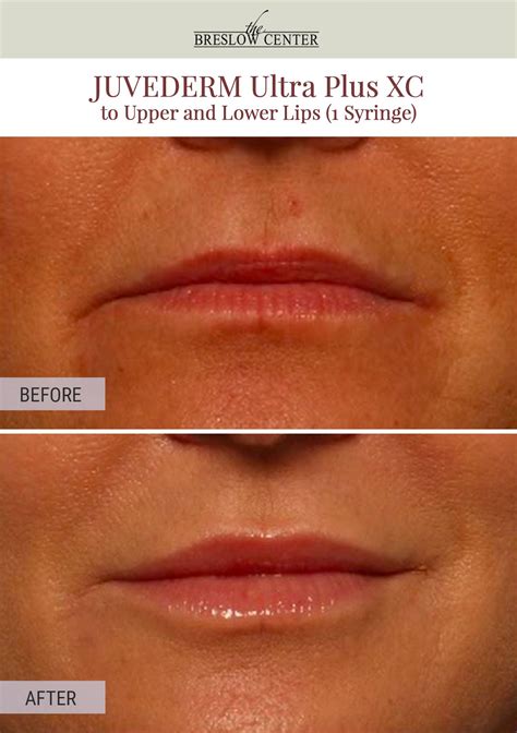 Procedure Juvederm Ultra Plus Xc To Upper And Lower Lips Syringe Dr Breslow And Dr