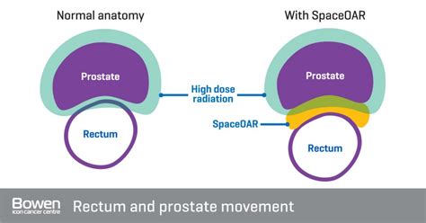 Spaceoar Prostate Hydrogel Spacer Bowen Icon Cancer Centre