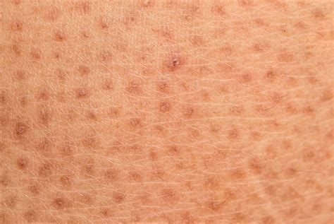 Scaly Dry Skin Learn About Ichthyosis Health And Detox And Vitamins