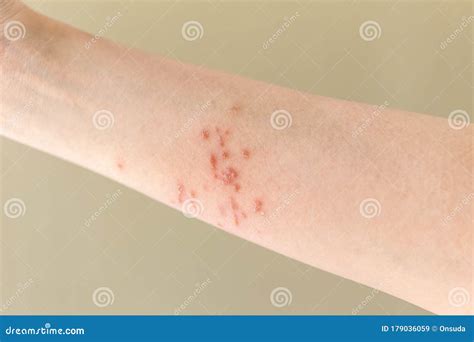 Arm With Psoriasis Stock Image Image Of Dermatology 179036059