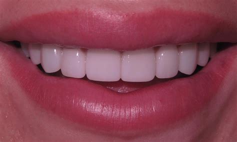 Cosmetic Dentist Edina Mn Porcelain Veneers For A New Smile