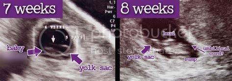 8 Week Ultrasound