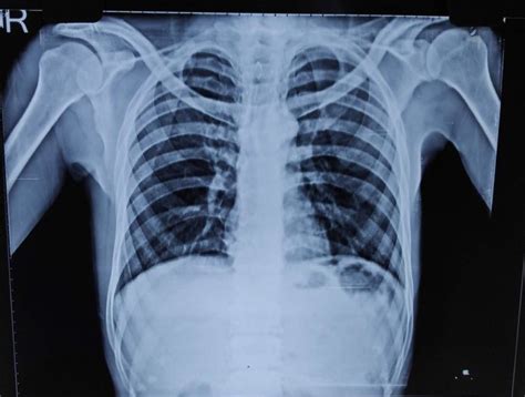 Erect Chest Radiograph Showing Air Under The Diaphragm Suggestive Of