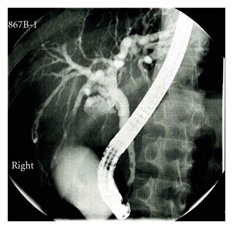Ercp Showing Irregular Wall Contours Variable Intrahepatic Stenoses