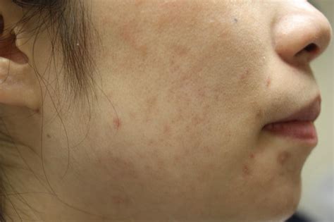 Acleara Acne Therapy Queens Long Island Nyc