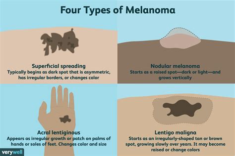 Malignant Melanoma Early Melanoma Symptoms Doctor Heck