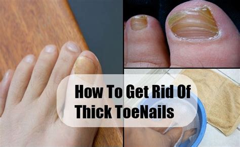 How To Get Rid Of Thick Toenails Thick Toenails Toenail Fungus Toe