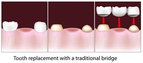 Dental Implants Ryde Gladesville And Meadowbank Putney Dental Care