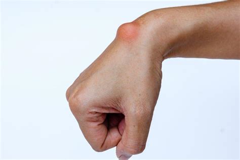 Ganglion Cyst Carpal Tunnel Surgery Clinic