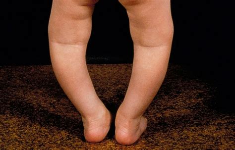Vitamin D Supplementation Has No Effect On Rickets Or Growth In Stunted