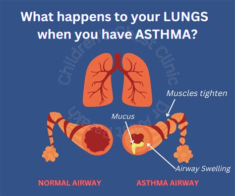 What Happens To Your Lungs When You Have Asthma Dr Ankit Parakh