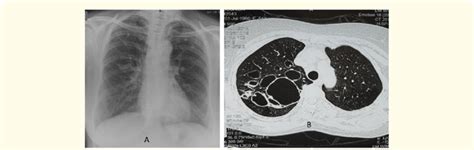 3a X Ray Chest Showing Thin Walled Cysts In Ruz 3b Hrct Thorax