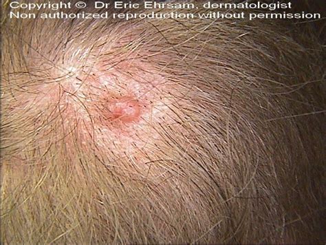 Dermoscopy Basal Cell Carcinoma