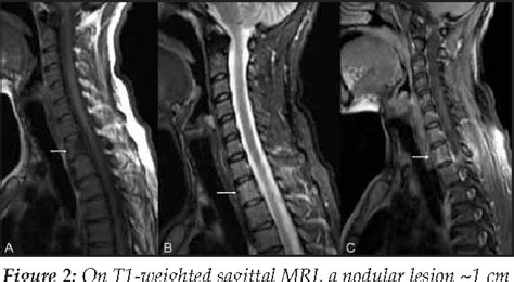 Osteoid Osteoma Spine Mri