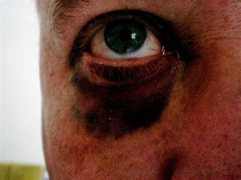 Black Eye 16 66 Hours Swelling Going Down No Flash Dion Gillard