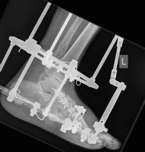 The following 3 pages use this file: Behandlung von Fußwurzelinstabilitäten bei Charcot-Fuß mit ...