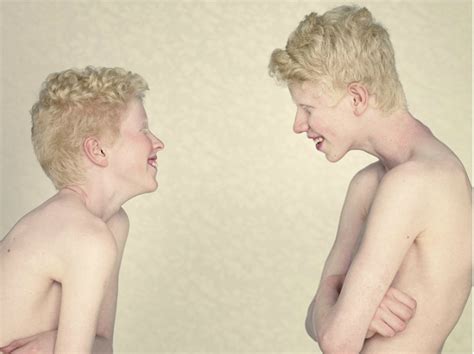 Types Of Albinism Albinism