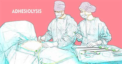 Adhesiolysis What Are Adhesions And What Is Adhesiolysis