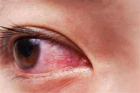 आंखों में कैसे होता है सूजन और लालिमा जाने कैसे करें इलाज News Aroma