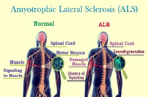 amyotrophic lateral sclerosis diagnosis and treatment care tips for living with als
