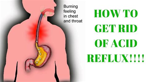 How To Get Rid Of Acid Reflux Burning In Throat Acid Reflux Treatment