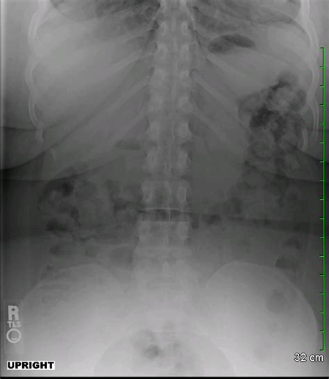 Archive Of Unremarkable Radiological Studies Abdominal X Ray Kub