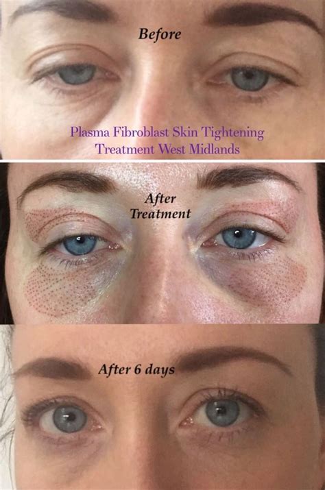 Ways To Get Rid Of Hooded Eyelids At Home Skin Tightening Treatments