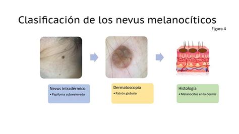 Dermatólogo Experto En Lunares O Nevus Madrid