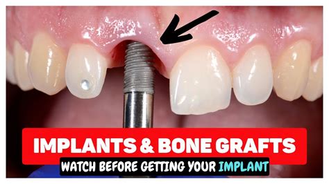 Dental Implants And Bone Grafting After Tooth Extractions Youtube