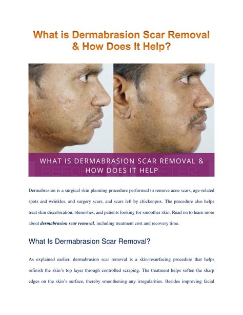 Ppt Dermabrasion Scar Removal What How Cost And Recovery Powerpoint