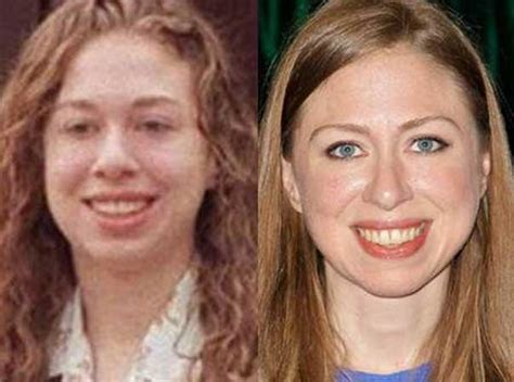 Chelsea Clinton Plastic Surgery: Nose Job, Chin Implant ...