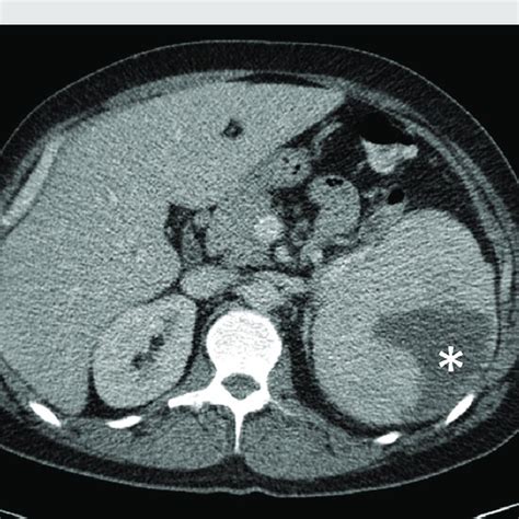 Ct Scan Of The Patient At Presentation The Splenic Rupture Is