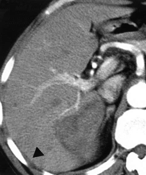 Dynamic Ct Of Hepatic Abscesses Significance Of Transient Segmental