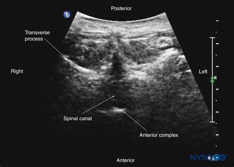 Ultrasound Imaging Of The Lumbar Spine For Central Neuraxial Blocks Images