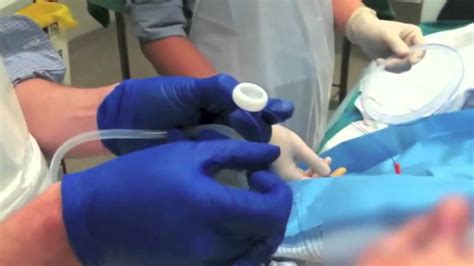 Peg Tube Insertion Video Youtube