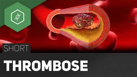 (pathology) the formation of thrombi in the blood vessels of a living organism, causing obstruction of the circulation. Thrombose - Rettung durch Strümpfe?! - #TheSimpleShort ...
