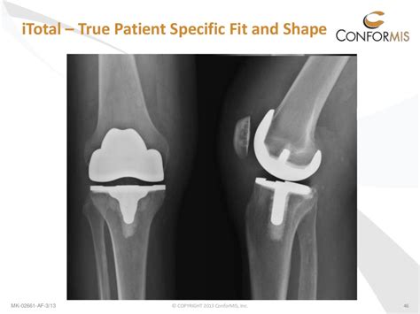 Conformis Patient Specific Custom Total Knee Replacement