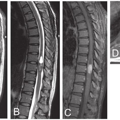 Magnetic Resonance MR Imaging Of The Thoracic Spine Showing A Download Scientific Diagram