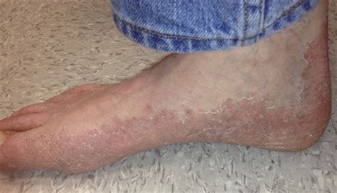 Hiv Rash On Feet