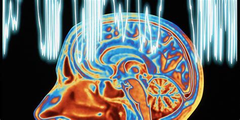 Epilepsie Ausgrenzung Oft Schlimmer Als Krankheit Selbst Neurologie