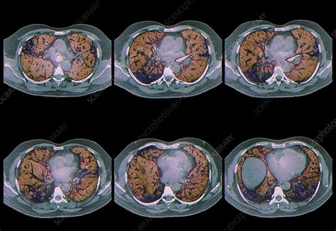 Interstitial Lung Disease Ct Scan Stock Image C0132186 Science