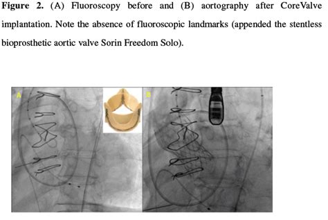 Challenging Transfemoral Valve In Valve Implantation In A Degenerated