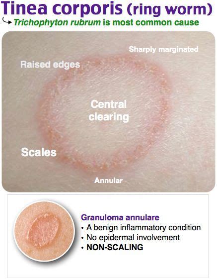 Pityriasis Rosea Vs Ringworm Hubpages Images And Photos Finder