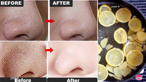 Remove Blackheads From Your Nose Clogged Pores Blackheads Bumps