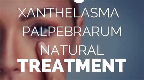 Xanthelasma Palpebrarum Natural Treatment What Works Best Youtube