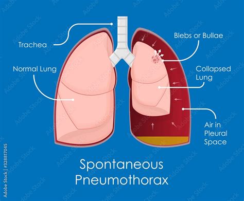 Symptom Spontaneous Iatrogenic Traumatic Pneumothorax Patient With