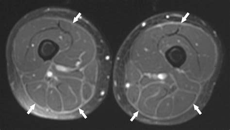 Mri For Diagnosis And Monitoring Of Patients With Eosinophilic